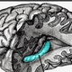 Illustration for article titled Obat Stroke Lumpuh Sebelah